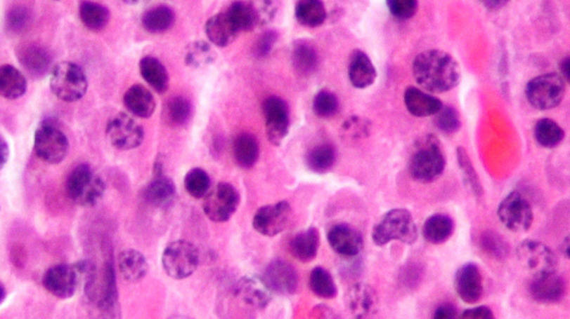 mieloma multiplo