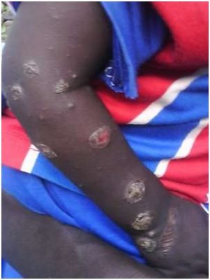 darfur-feridas-circulares